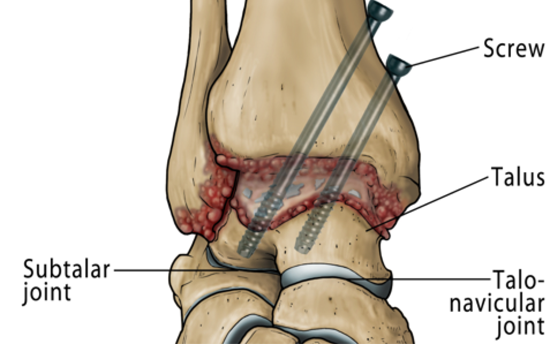 Ankle Fusion Surgery | MyAnkle | Ankle Surgeon London