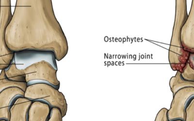 What Is Ankle Arthritis?