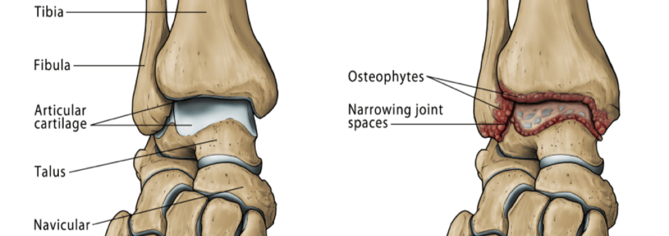 What Is Ankle arthritis and Osteoarthritis?