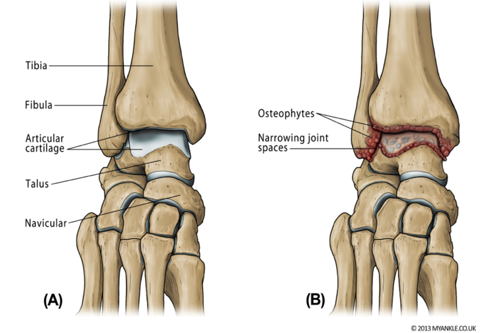 Ankle Osteoarthritis image ankle surgery London