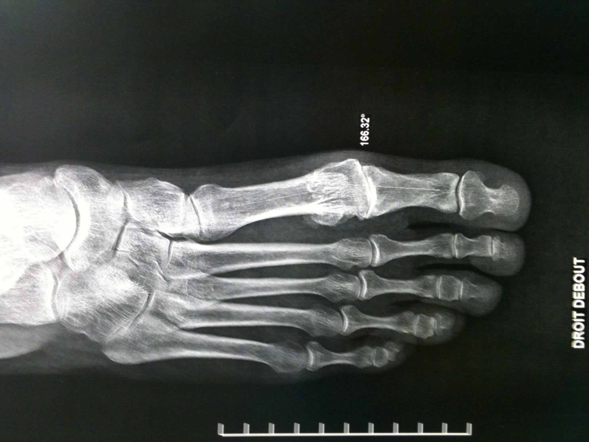 Hallux Rigidus Painful Big Toe Myankle Ankle Arthritis Surgery