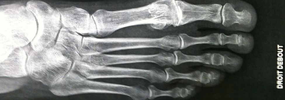 Hallux Rigidus Painful Big Toe arthritis
