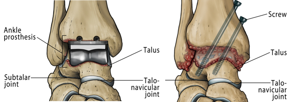 Ankle Replacement Vs Ankle Fusion surgery London