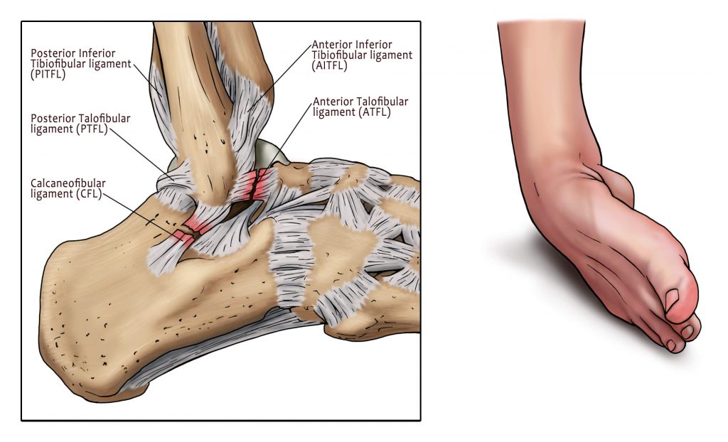 margen taske fe London ankle sprain - ankle sprained treatment - MyAnkle