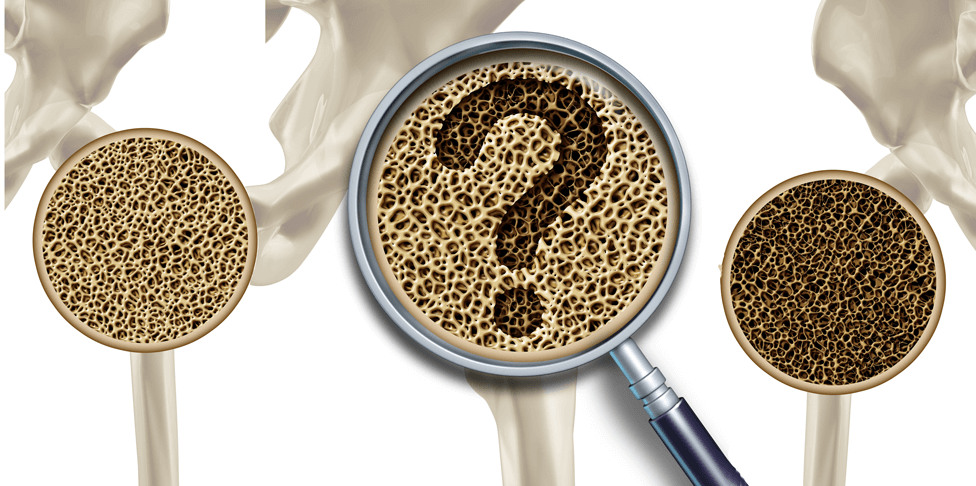 Difference between osteoporosis and osteoarthritis