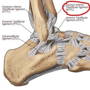 what is a high ankle sprain myankle