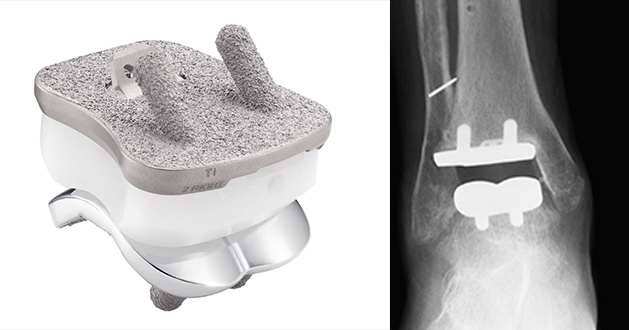 Cadence Ankle Replacement